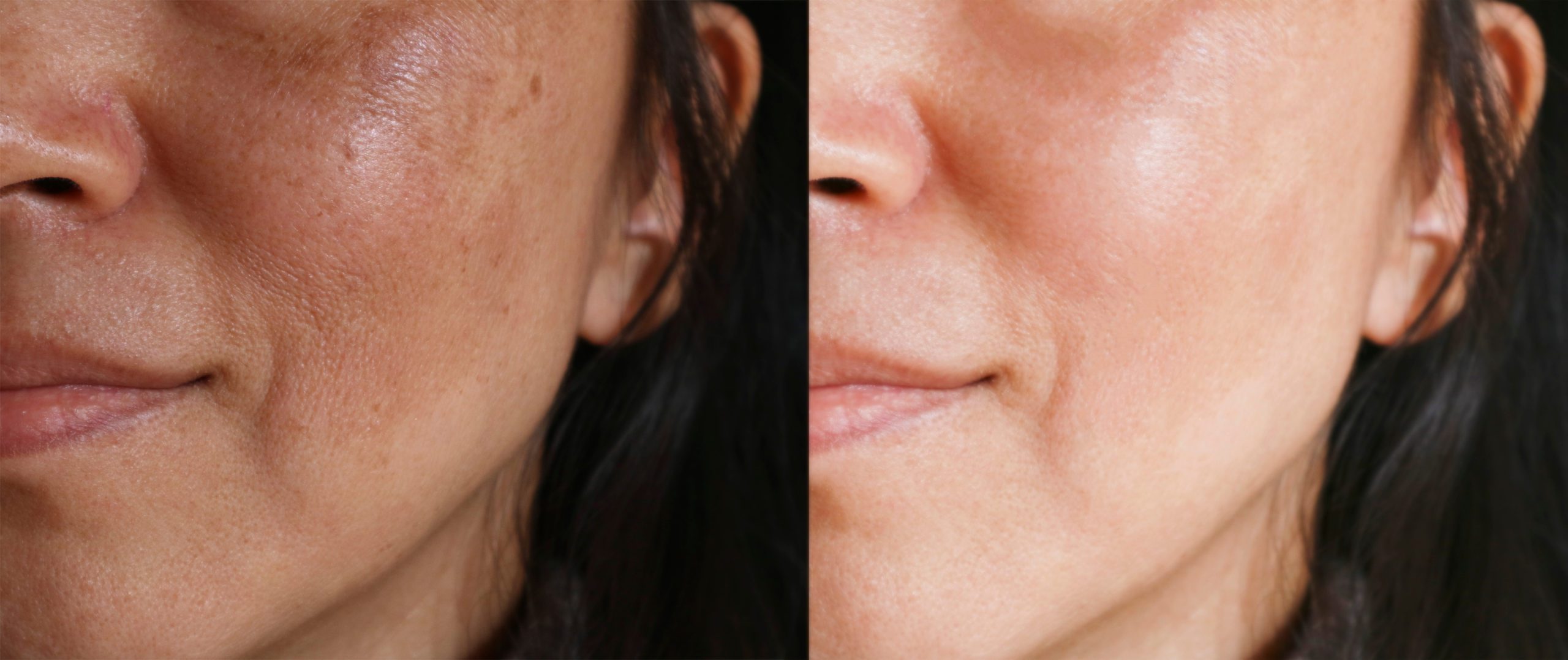 Aging skin treatment before/after
