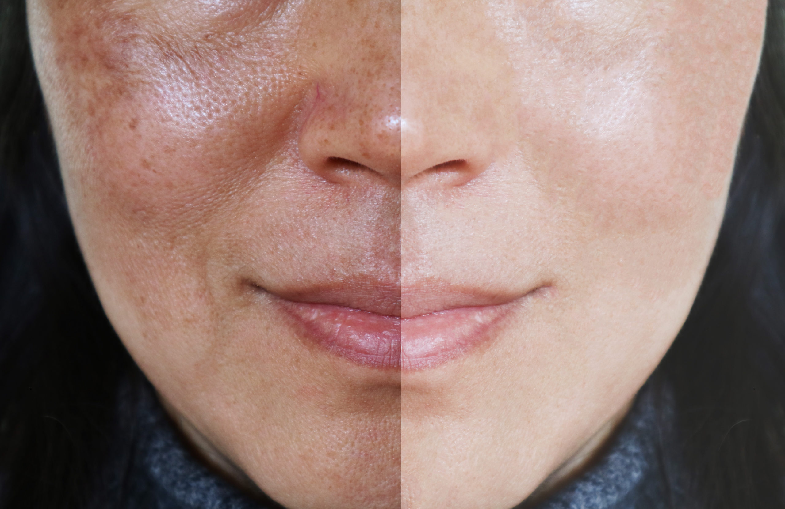 Skin consultation before laser resurfacing