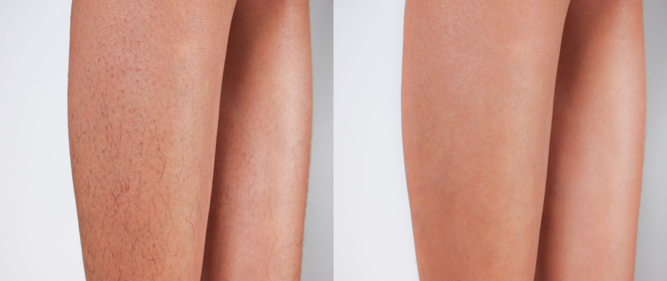 Clinic staff consulting acne scar removal