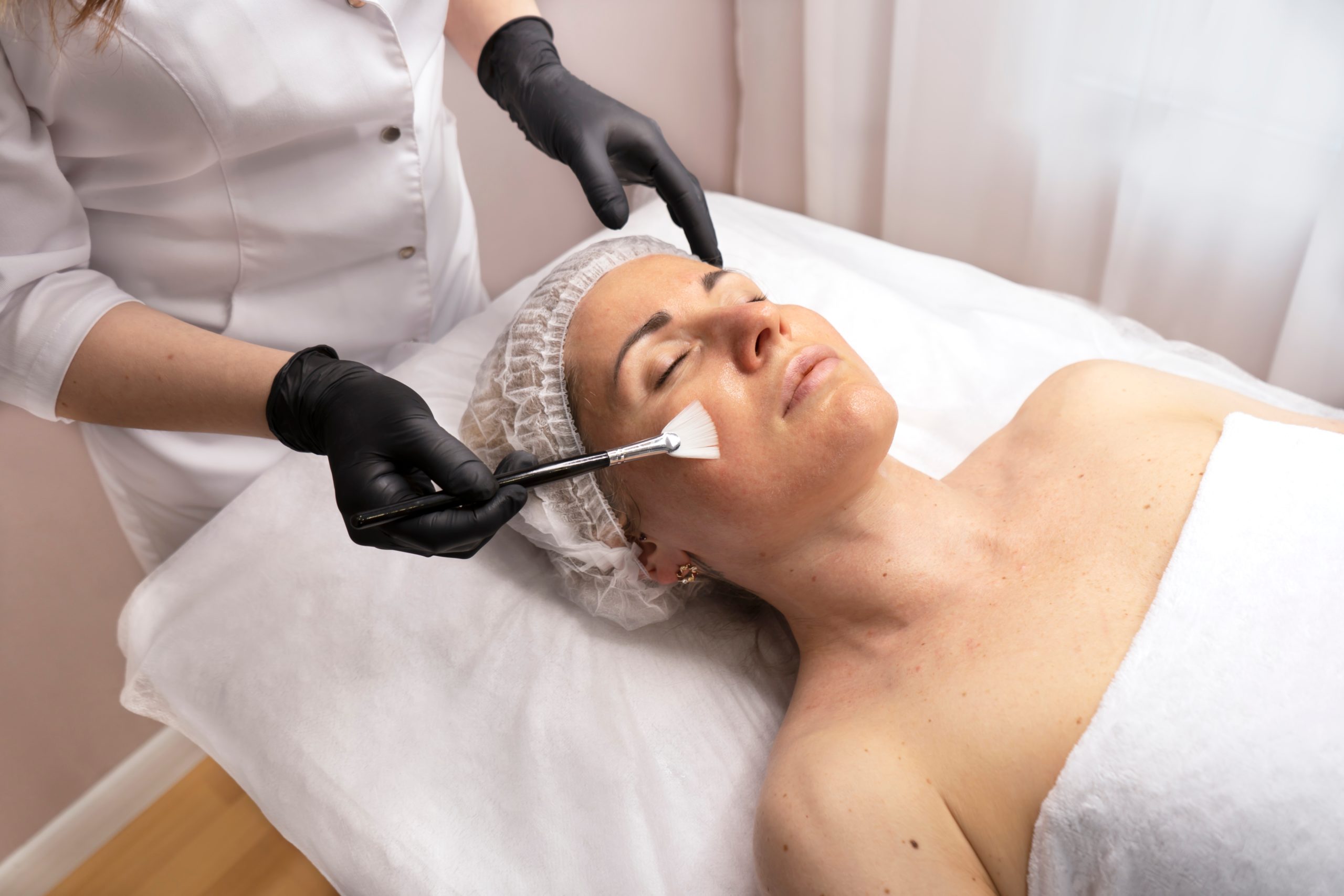 Chemical peel treatment explaining skin exfoliation